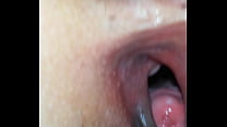free wide cunt hysteroscopy video